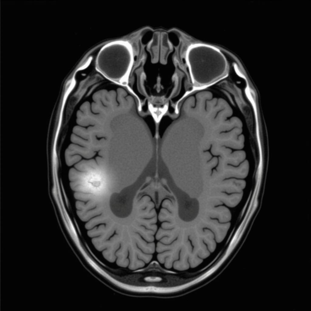 Hình ảnh CT Scan cho thấy khối u não