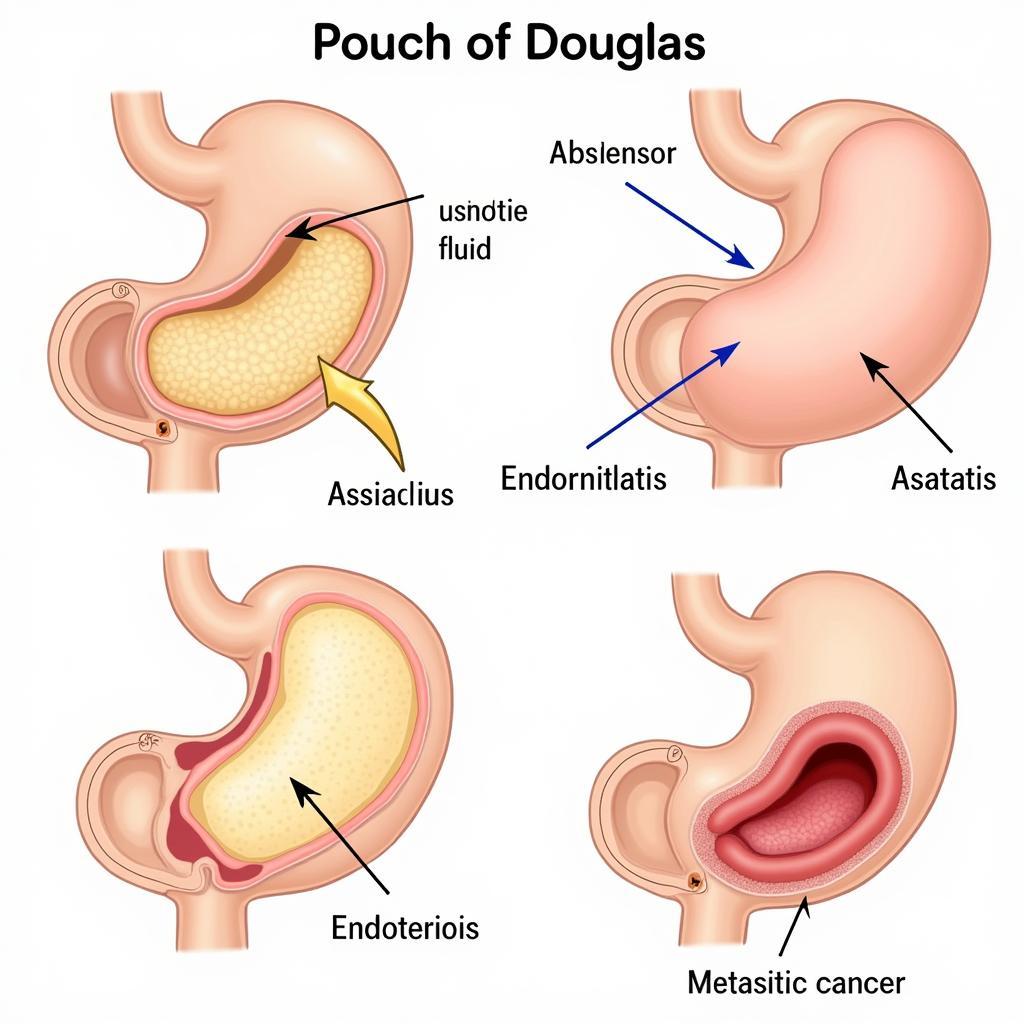 Các Bệnh Lý Liên Quan đến Túi Cùng Douglas